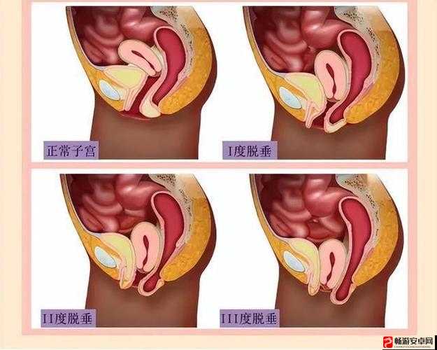 女性阴挺病：其究竟是怎么回事儿呢